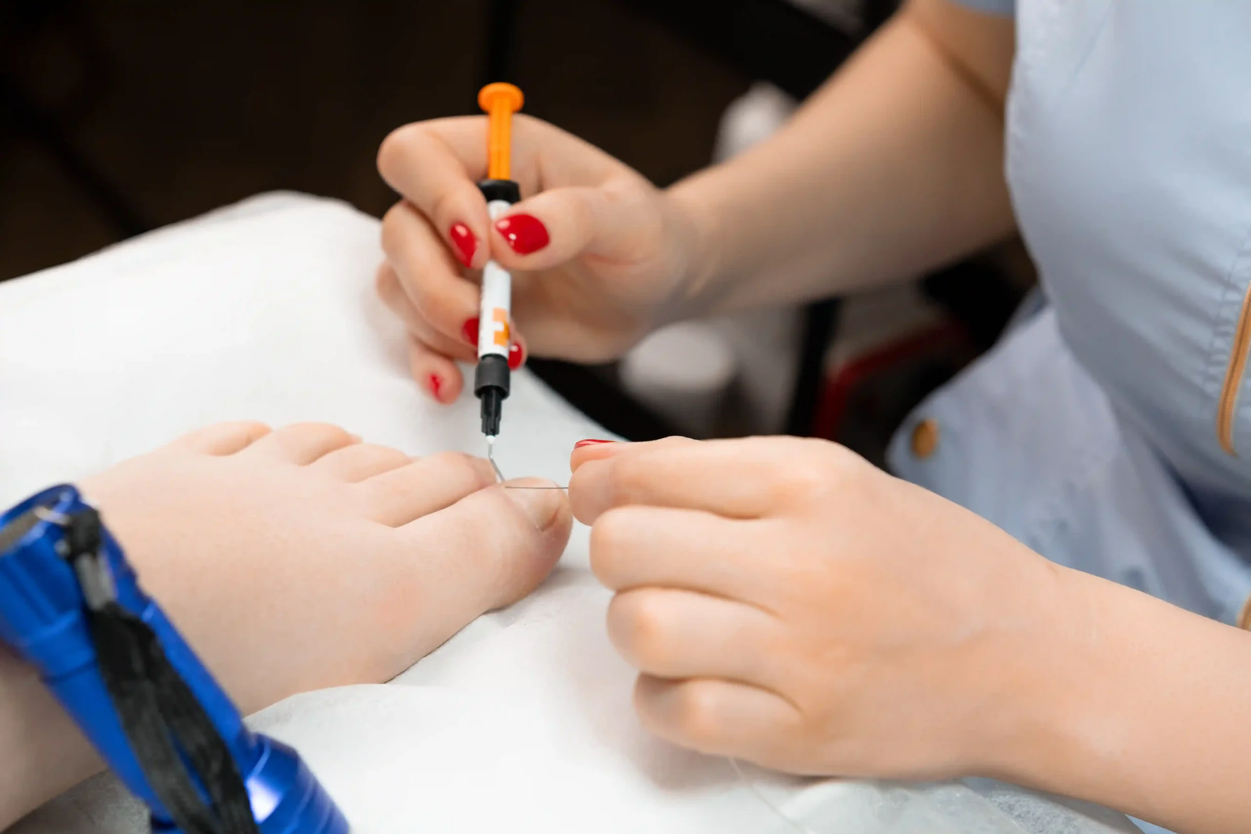 Nagelkorrekturspangen Podologie Bielefeld